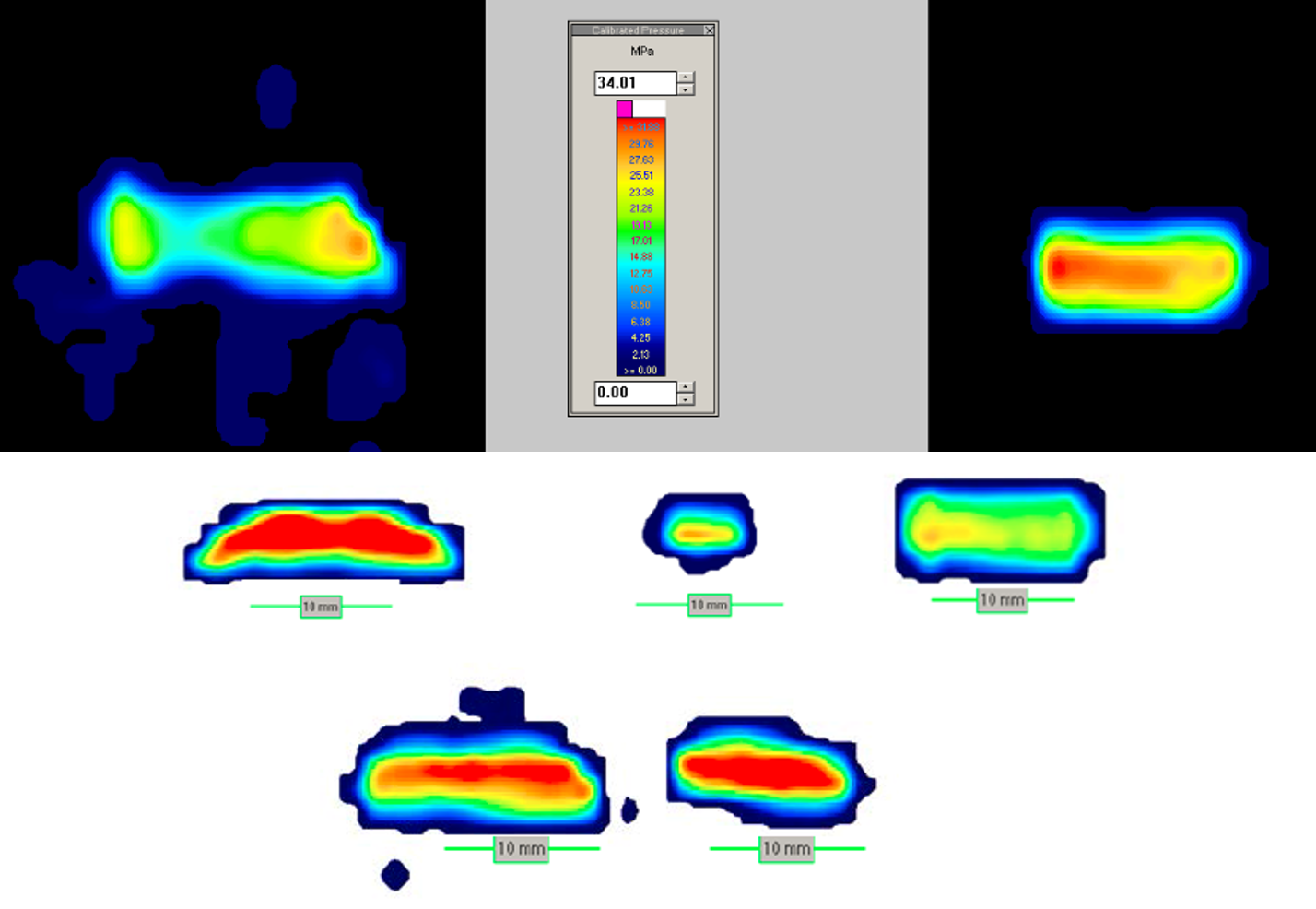 Knee Implant Tekscan results