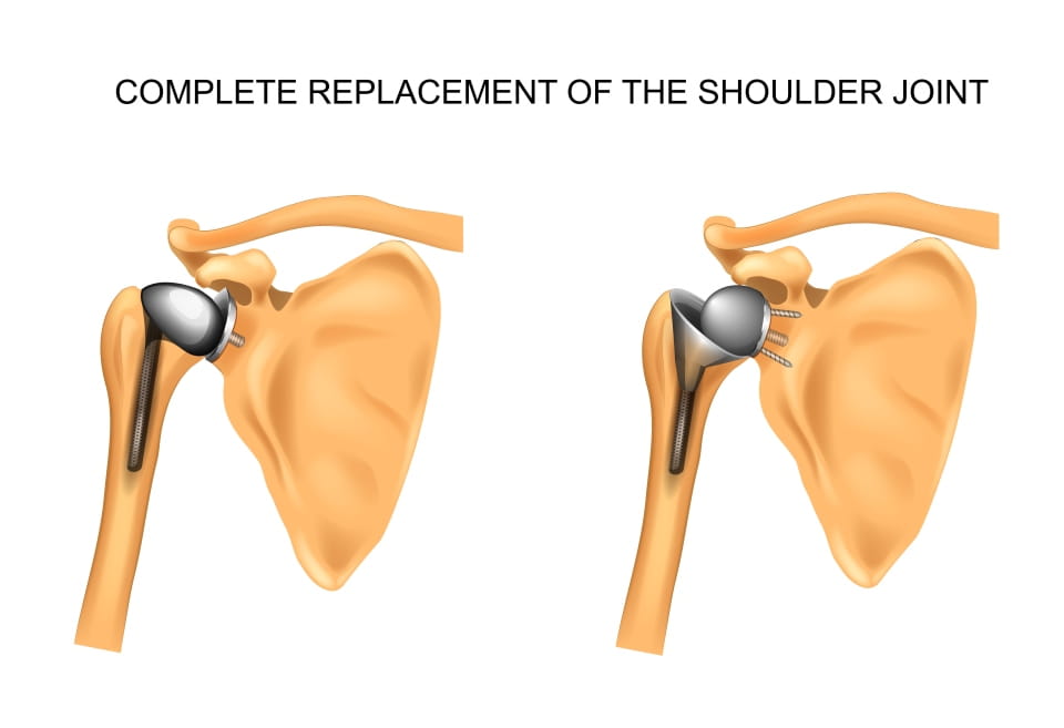 Preventing Glenoid Component Failure In TSR Element   Preventing Glenoid Component Failure Publication Image 1 